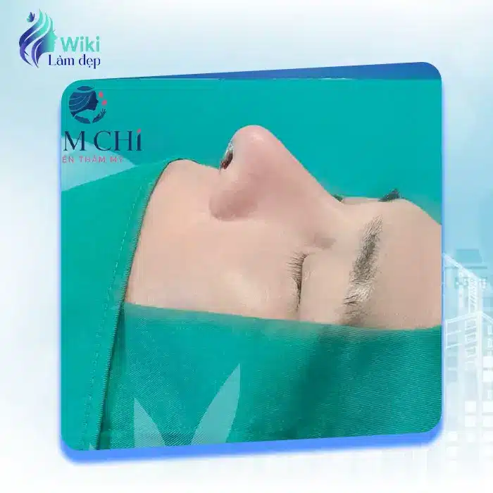 Top 7+ Địa Chỉ Nâng Mũi Uy Tín, An Toàn Tại Bình Dương Năm 2024