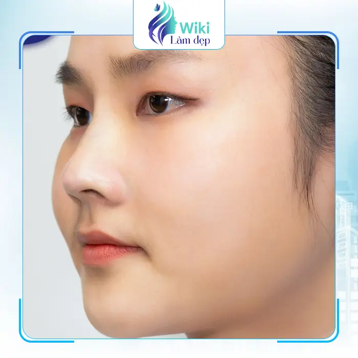 Top 7 Địa Chỉ Nâng Mũi Tại Bà Rịa – Vũng Tàu Uy Tín