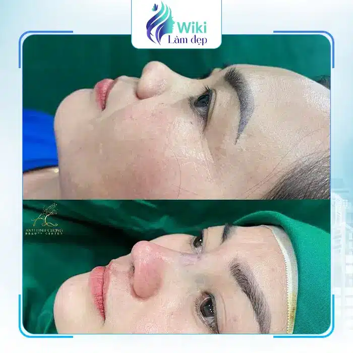 Top 7 Địa Chỉ Nâng Mũi Tại Bà Rịa – Vũng Tàu Uy Tín