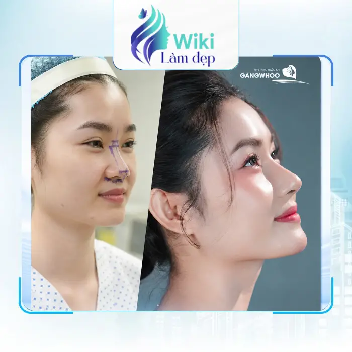 Top 7 Địa Chỉ Nâng Mũi Tại Bà Rịa – Vũng Tàu Uy Tín