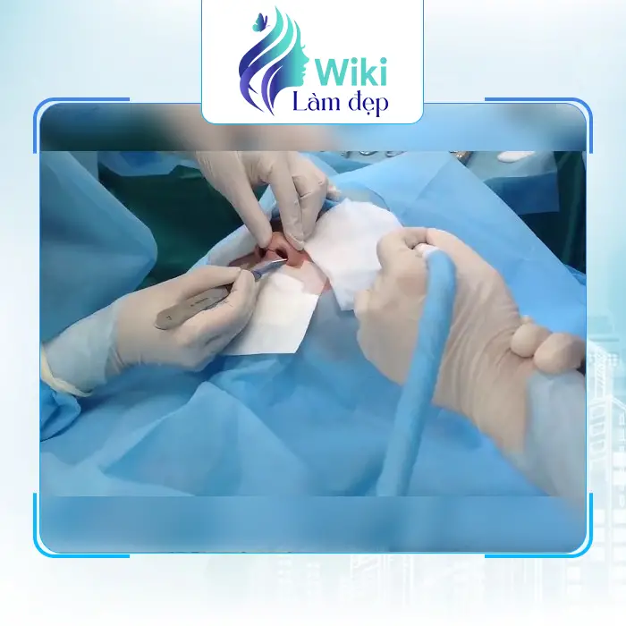 Top 7 Địa Chỉ Nâng Mũi tại Quận 5 TP.HCM Được Khách Hàng Yêu Thích