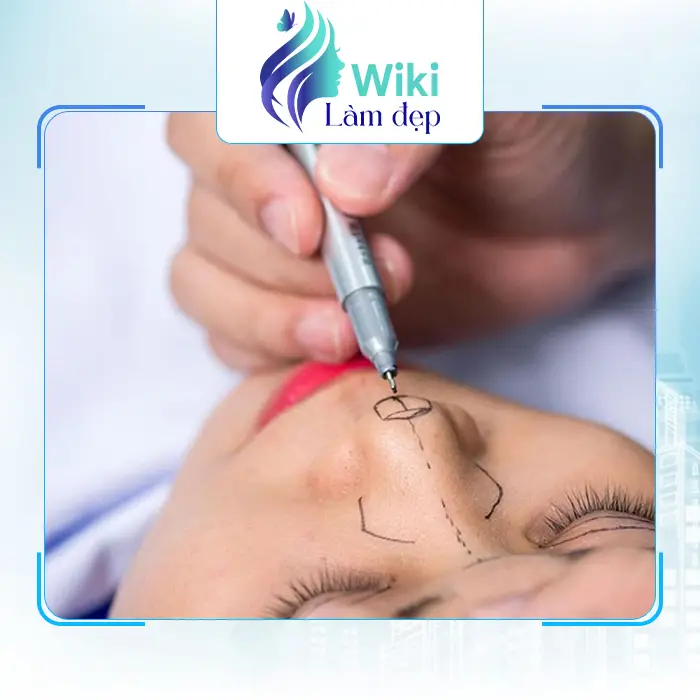 Top 7 Địa Chỉ Nâng Mũi tại Yên Bái Top Đầu Uy Tín & Chất Lượng