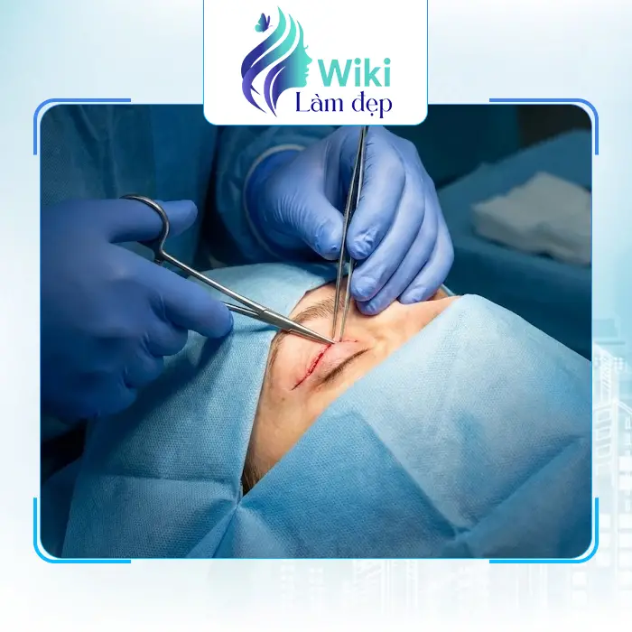 Top 7 địa chỉ cắt mí mắt tại Khánh Hòa uy tín