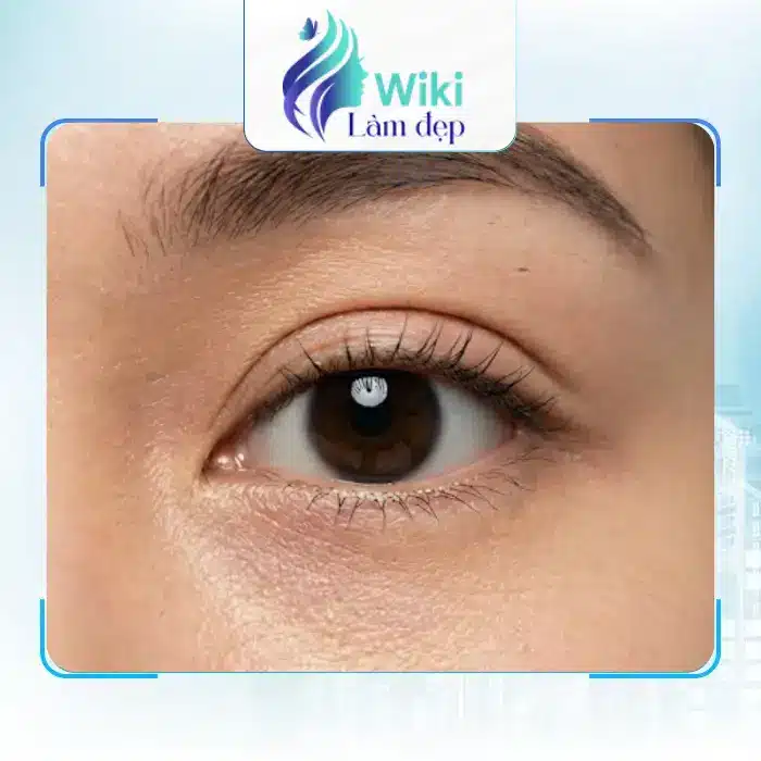 Review 5 địa chỉ Cắt mí mắt tại Quảng Bình uy tín