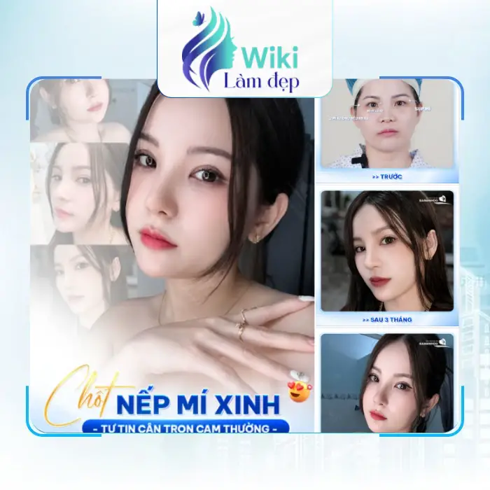 Top 4 địa chỉ cắt mí mắt Đẹp tại Thủ Đức được quan tâm