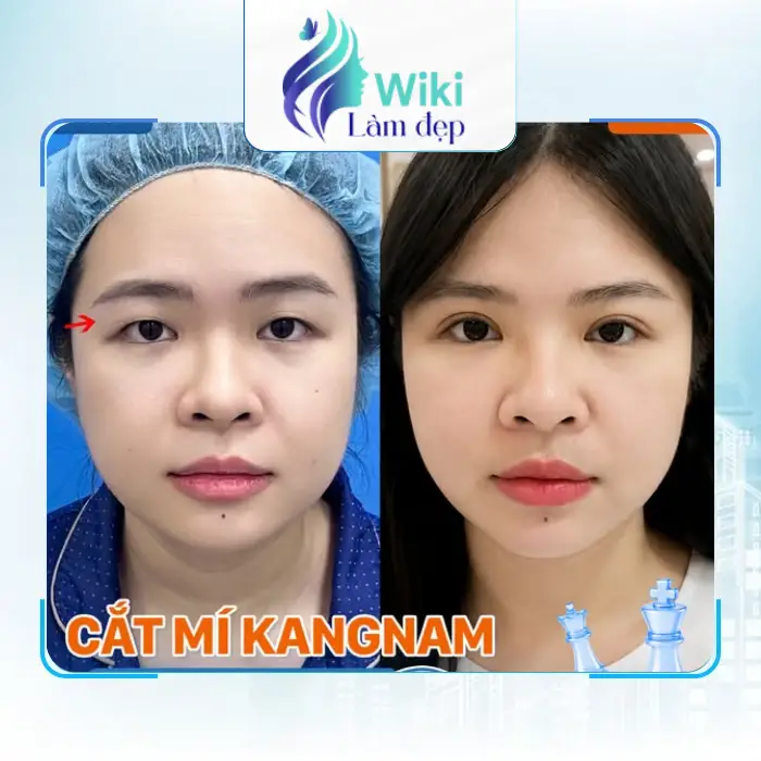 Top 4 địa chỉ cắt mí mắt Đẹp tại Thủ Đức được quan tâm
