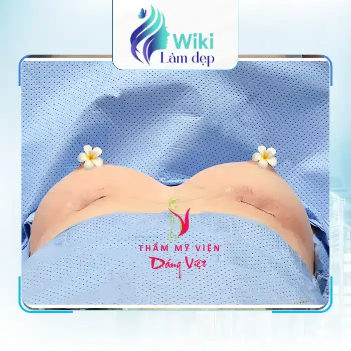 nâng ngực tại Cần Thơ