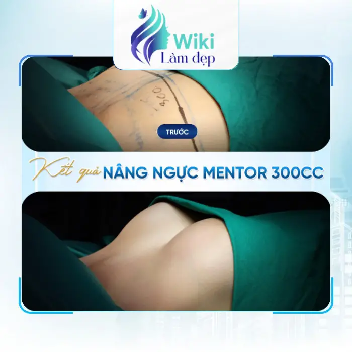 Tìm Hiểu 4 Địa Chỉ Nâng Ngực Tại Nghệ An Được Nhiều Chị Em Lựa Chọn