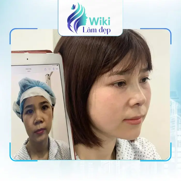 Căng Da Mặt Tại Cao Bằng Ở Đâu? Gợi Ý 5 Địa Chỉ Uy Tín Gần Bạn