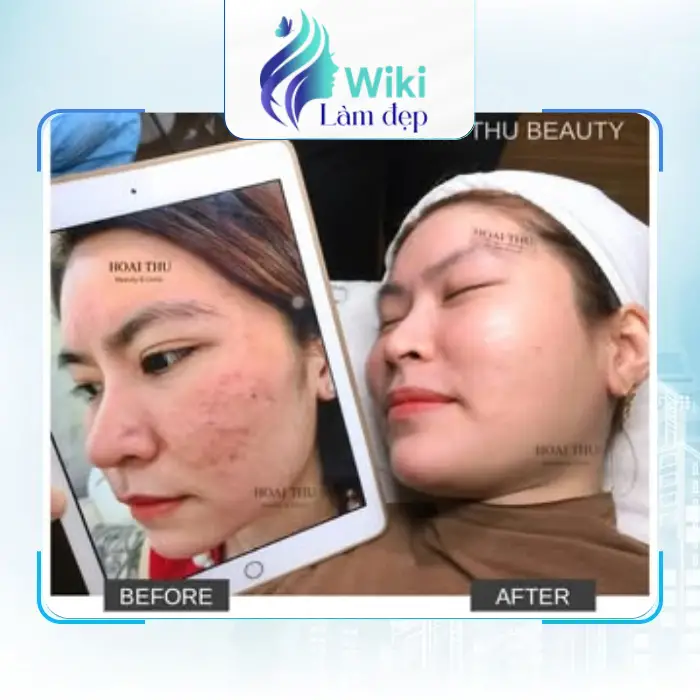 Căng Da Mặt Tại Thái Nguyên Tìm Hiểu 3 Địa Chỉ Chăm Sóc Da Uy Tín