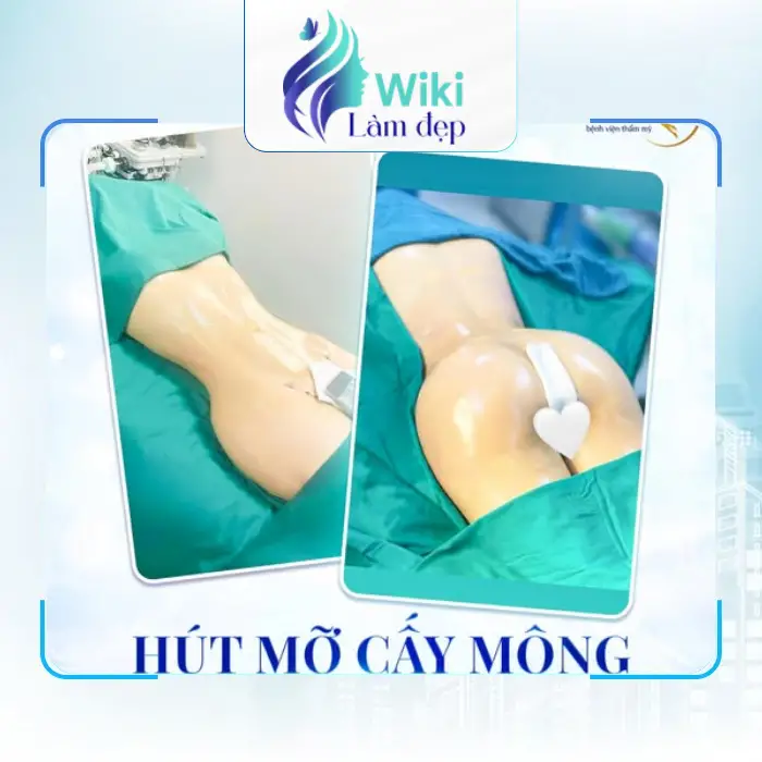Nâng Mông Tại Hà Giang – Gợi Ý 8 Địa Chỉ Nâng Vòng 3