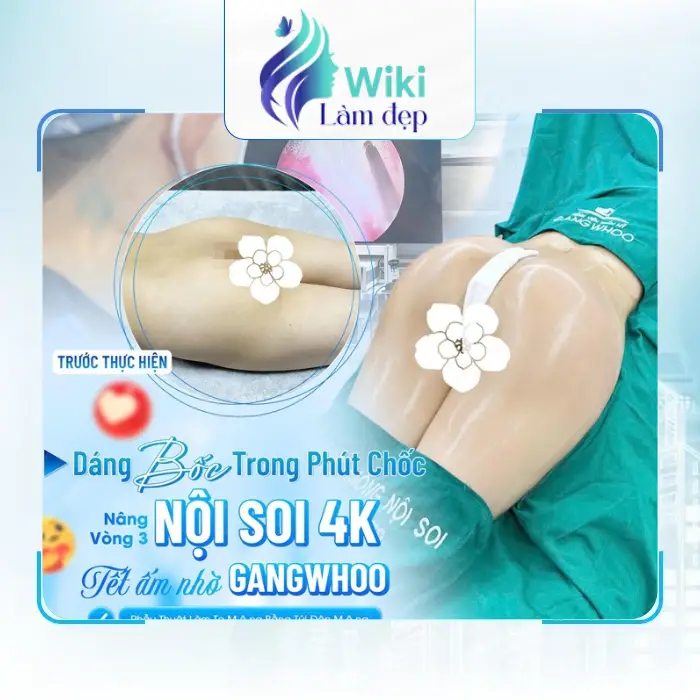 Nâng Mông Tại Nam Định – Tham Khảo 4 Địa Chỉ Lân Cận