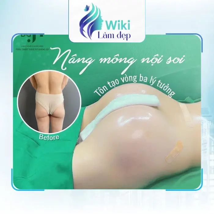 Nâng Mông Tại Nghệ An – 4 Địa Chỉ Để Tham Khảo
